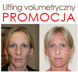 Lifting volumetryczny
