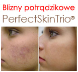 Blizny potrądzikowe