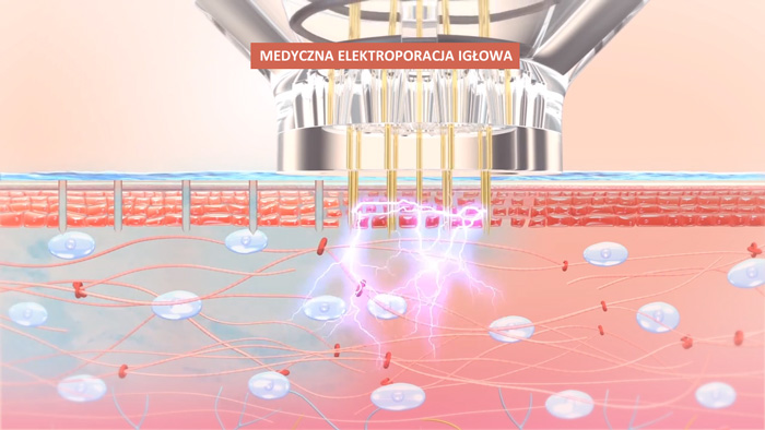 Medyczna elektroporacja igłowa