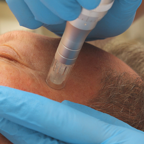 Mezoterapia mikroigłowa Dermapen